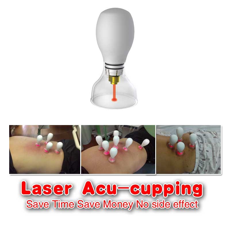 Laser Acu-Cupping